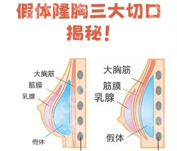 成都华西医院丰胸手术价格更新！假体隆胸低至4w起！透明收费不踩坑