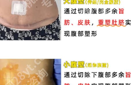 上海第一人民医院腹壁整形专家有哪些？医生来帮忙！