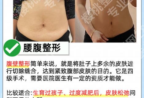 中山大学附属第一医院腹壁整形专家有哪些？医生他来了！