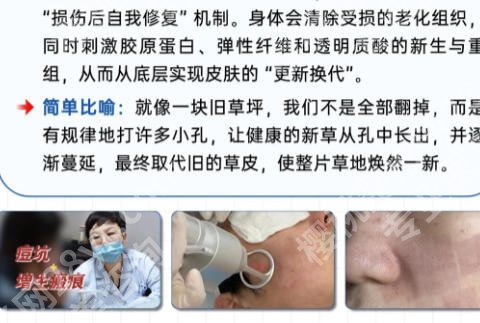 宿迁点阵激光多少钱一次？低至3k元起价格透明！