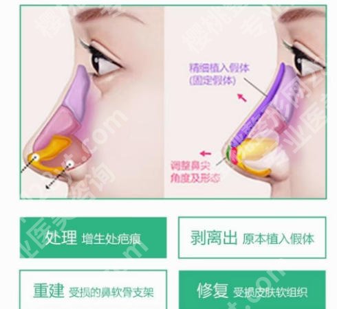东莞鼻修复出名的医院有哪些？2026排行榜更新！这五家医院榜上有名！