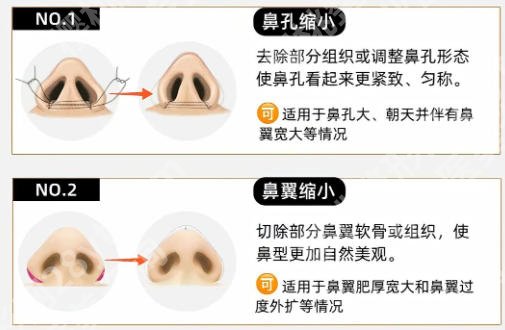 济宁隆鼻哪个医生好？刘郭、孔祥红等医生学术知识渊博、技术手法精细