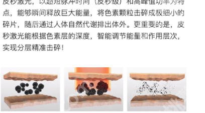 聊城激光祛斑哪里好？这些祛斑医院值得一试！