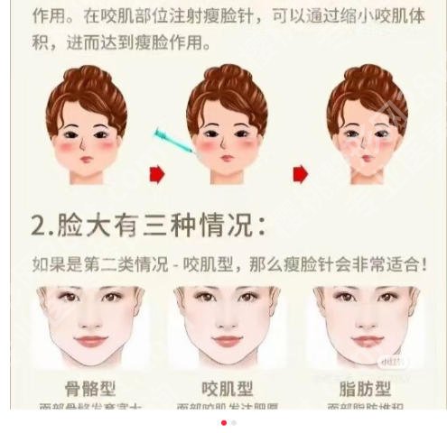 南昌哪里打瘦脸效果好？这几家医院技术在线实力不俗！