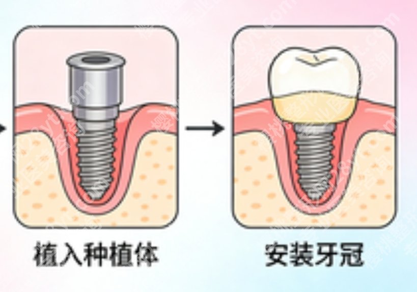 乌鲁木齐种植牙医生排名，这几位医生关注度高，附选择方向分析