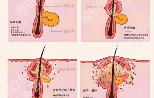 蚌埠祛痘医院哪家好?蚌埠一院、蚌埠三院等五家医院祛痘实力超群!