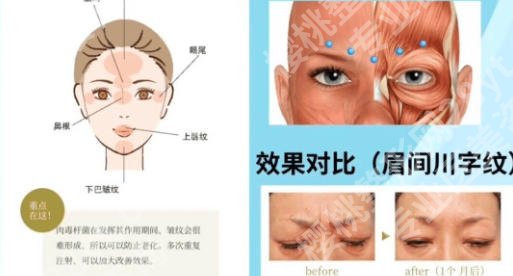 济南打除皱注射哪家好？实力排名与价格分析帮助你找到靠谱选择！