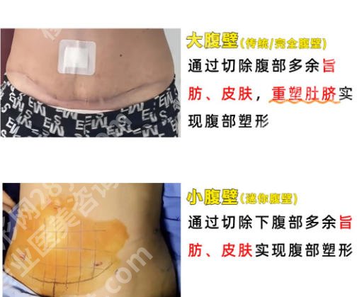 上海第十人民医院腹壁整形怎么样？真实用户口碑来袭！就诊必看！