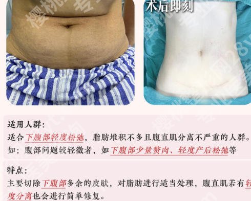 江南大学附属医院腹壁整形专家公布！史高峰等医生技术沉稳，值得信赖！