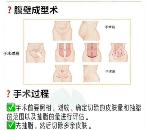 珠江医院腹壁整形专家有哪些？齐向东、张吉人气医生的技术值得信赖附真实案例分享！