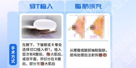 北京联合丽格隆胸怎么样？杨大平和罗忠振教授隆胸案例与价格全指南！
