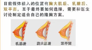 成都华生铂悦隆胸怎么样？医院简介|热门项目|技术点评！