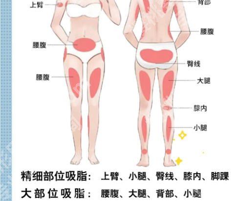 成都怡脂医疗lams吸脂怎么样？内含医院详细介绍及科普问答等你来了解！