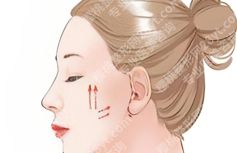 双鸭山哪里做双眼皮好？埋线、全切、提肌怎么选，看完少走很多弯路