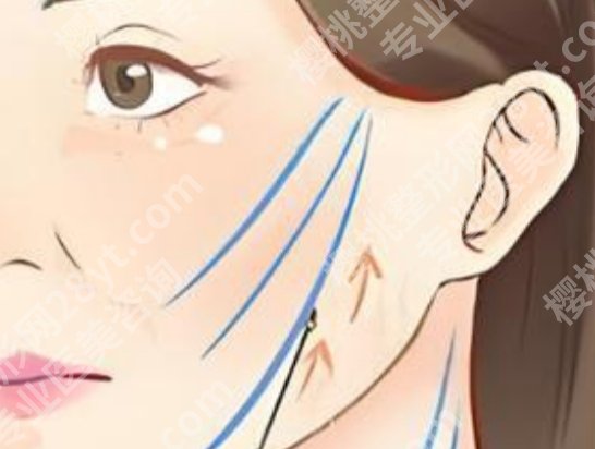 哈尔滨拉皮手术费多少钱？手术价格高低通常差在这几项