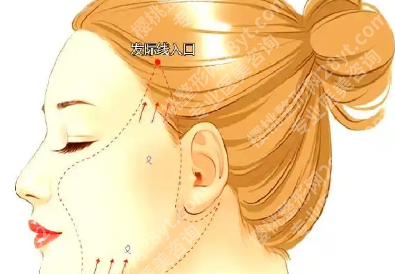 哈尔滨拉皮手术价格是什么？收费到底怎么看，这篇说得更直白