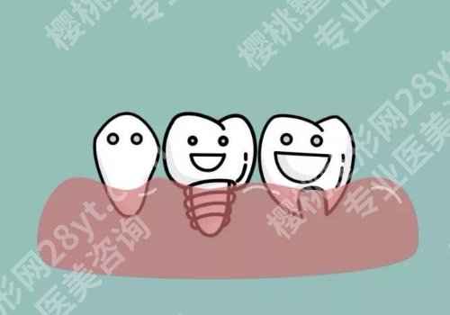 揭阳种牙多少钱一颗？5K起步、高性价比医院排名榜公开 