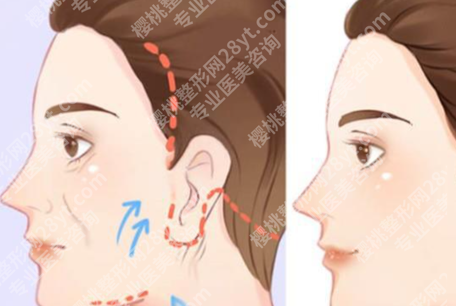 哈尔滨拉皮手术好的医生有哪些？技术、经验和面部审美风格都值得细看
