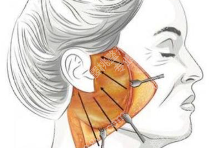 齐齐哈尔拉皮哪家做得好?从审美到恢复反馈,几个重点都替你整理了