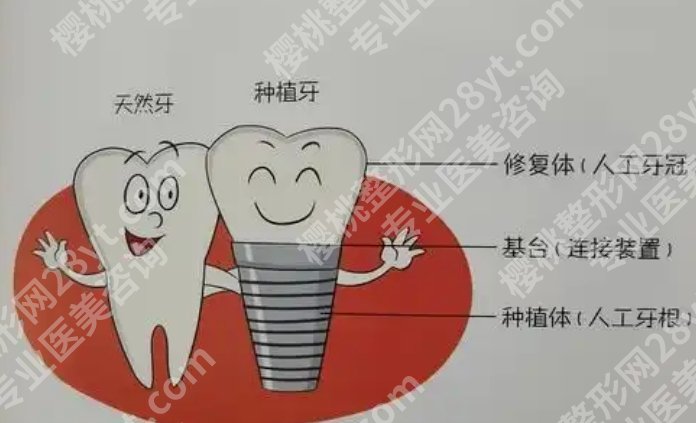 福州种牙哪里比较好的医院有哪些？靠谱机构都在这，种牙不踩坑