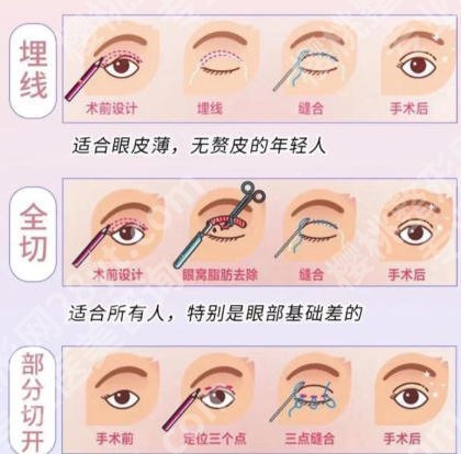 付巨峰医生做双眼皮怎么样？医生经验丰富值得信赖