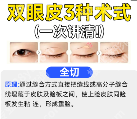 顾新安做双眼皮好吗？医生详情、坐诊医院及26年价格分享！