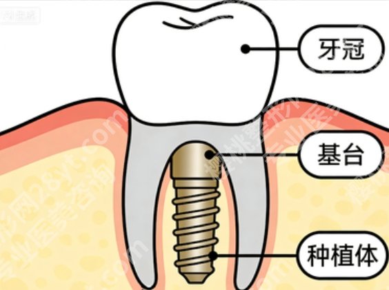 江门全口种植牙哪家好？做全口这几家技术口碑都在线，缺牙党速看