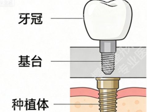 襄阳全口种植牙哪家好？做全口经验丰富的机构都在这了，建议收藏