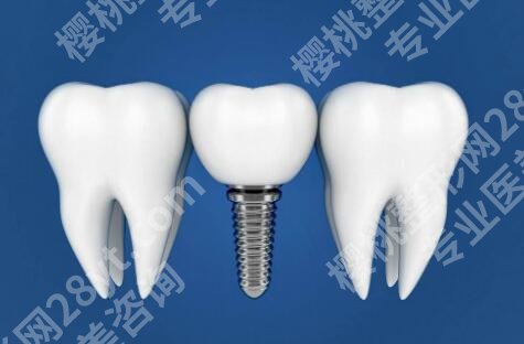 唐山口腔医院种牙多少钱？种牙价格明细与收费一一参考