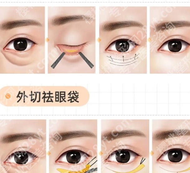 谢洪医生祛眼袋怎么样？医生信息、擅长项目公布！附面诊小技巧