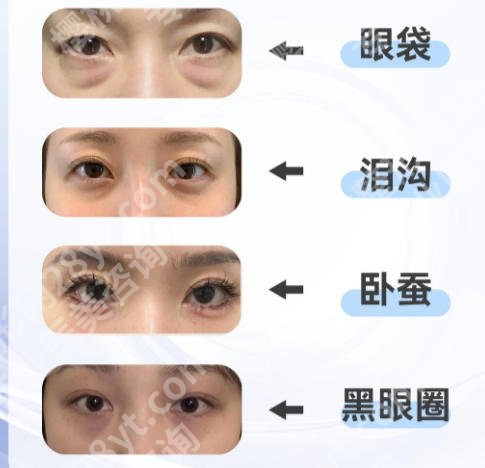荆州祛眼袋整形哪里好？附上祛眼袋手术案例分享和医院具体介绍