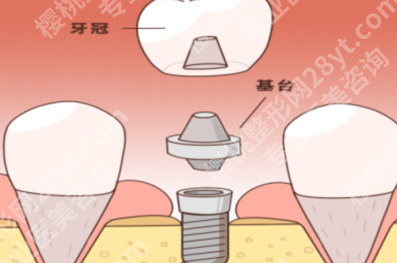 泰安种牙哪家医院好？热门医院名单公开，单颗缺牙到半口修复都能参考