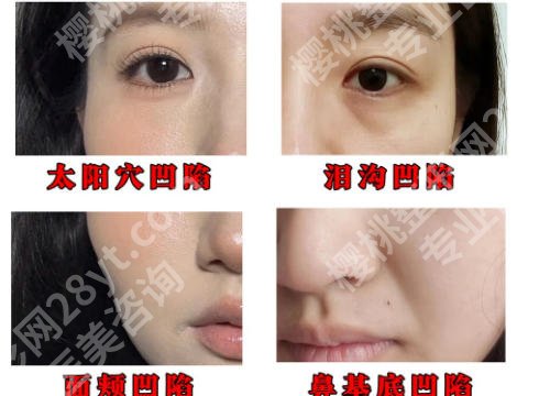 兰州哪里脂肪填充做得好?五家硬核医院名单公布!
