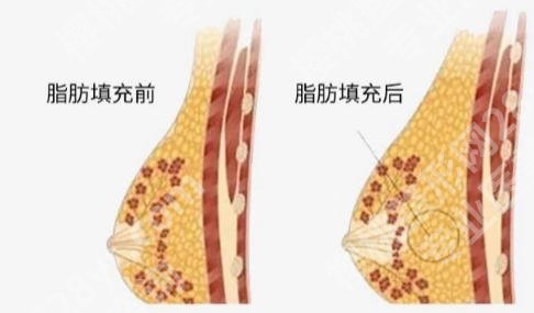 东莞注射隆胸多少钱一次啊？费用低至6万5左右！含推荐医院