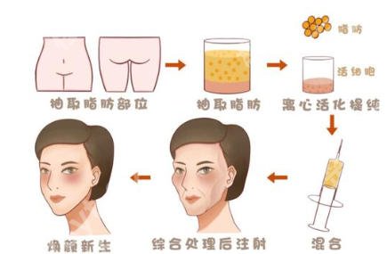 大连自体脂肪填充医生哪个好？李研、赵穆欣口碑在线！