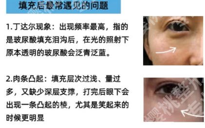 上海填充泪沟哪家医院好需要多少钱？东方医院、上海九院这几家口碑好又实惠