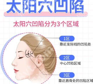 天津填充太阳凹脸颊大概多少钱?2026价格表更新!点击收藏