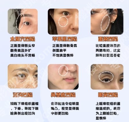 青岛注射玻尿酸微整技术好的医生都有谁？任纪祯、王彦进口碑在线！