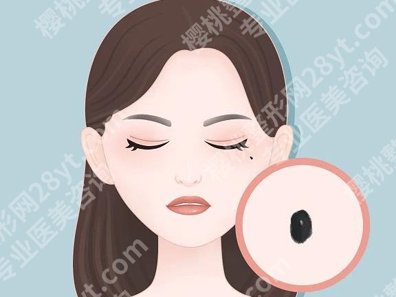 中山三院激光点痣一个多少钱？单颗收费明细整理|不踩坑