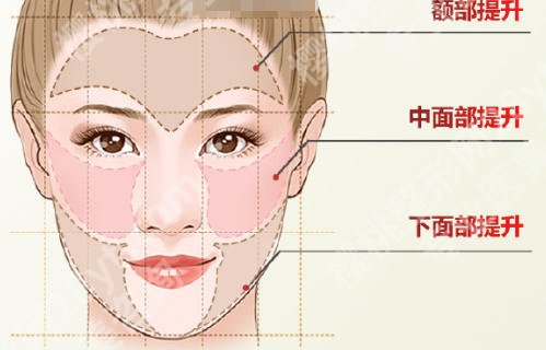广州面部提升腻害的医生名单更新！鲁峰、王雯婷技术口碑好！