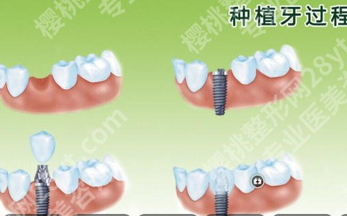 霍邱第二人民医院种植牙多少钱？核心项目技术剖析！国产种牙6k左右