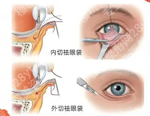 吉大二院去眼袋多少钱？价格在6486-14700元不等！就诊必看