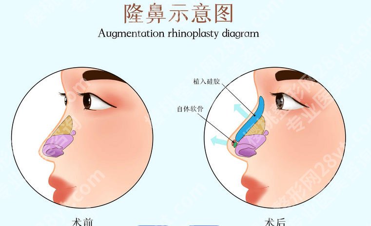彭千飞医生口碑如何？隆鼻技术超群！备受当地人好评