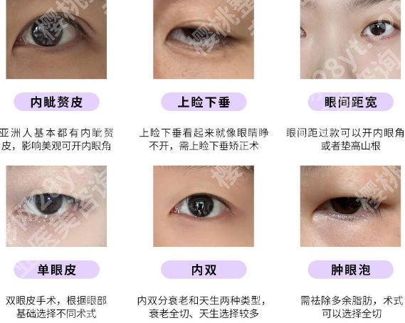 安医一附院割双眼皮多少钱？埋线双眼皮2千9起、微创双眼皮3千9左右！