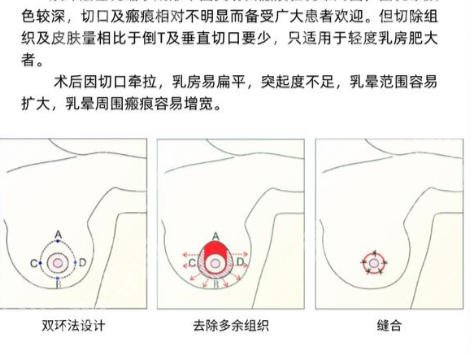 天津哪个医院可以做缩胸手术？热门整形医院推荐！