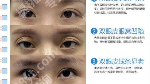 天津排名前十双眼皮修复医生有哪些？深度盘点不踩坑