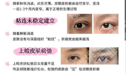 上海第六人民医院双眼皮医生名单公布！个个实力派值得信赖