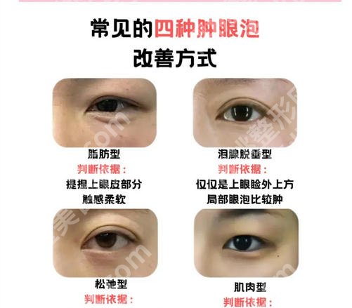 深圳双眼皮修复牛的医生名单更新！于丽/孙辉/王丽妮口碑在线