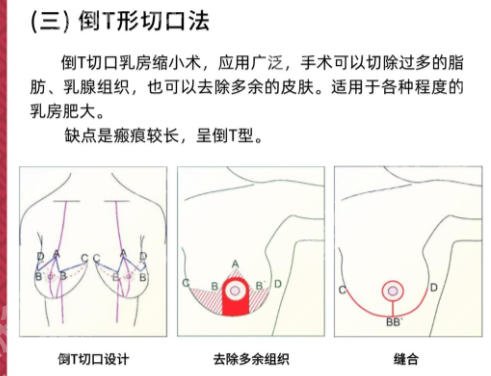 合肥哪里做缩胸手术比较好的？患者口碑筛选好地方