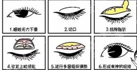 霍邱第二人民医院割双眼皮怎么样？眼部整形全流程记录！